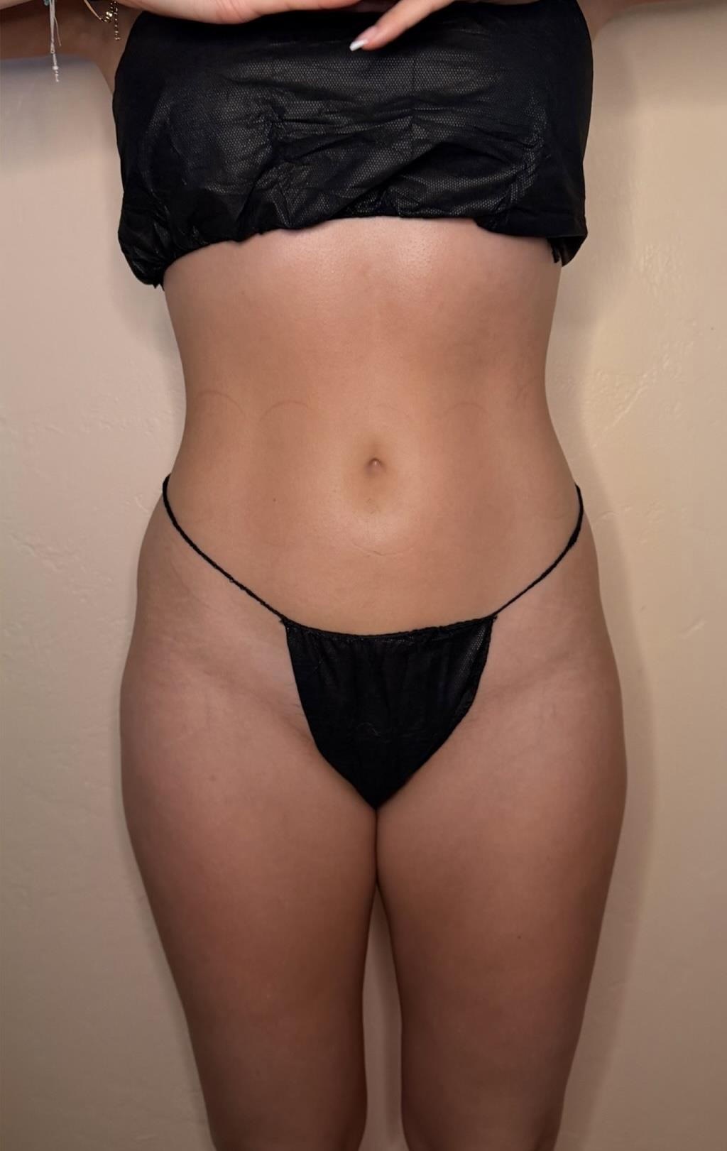 After — a real Sculpted by Lexi client's stomach, before and after a lymphatic drainage and sculpting series