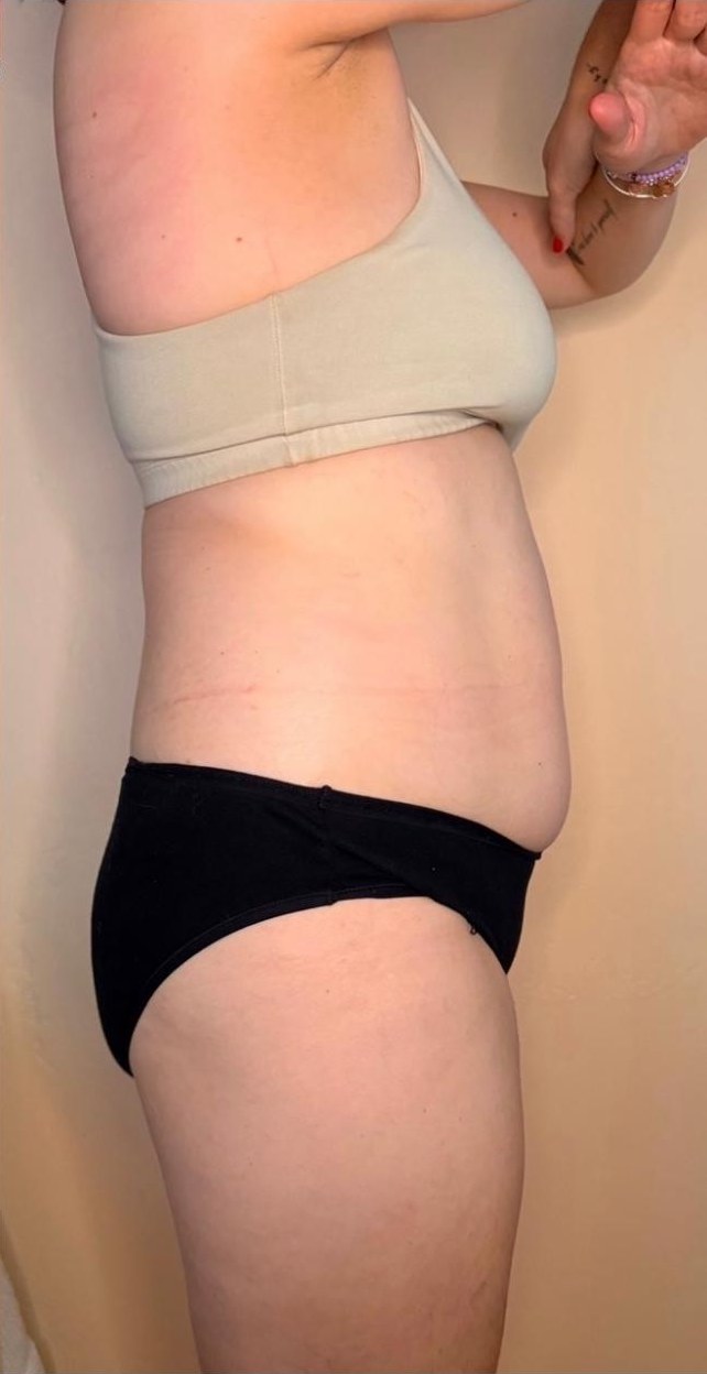After — a real client's waist, before and after a course of body sculpting sessions with Lexi