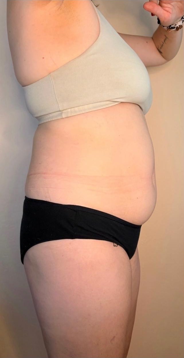 Before — a real client's waist, before and after a course of body sculpting sessions with Lexi
