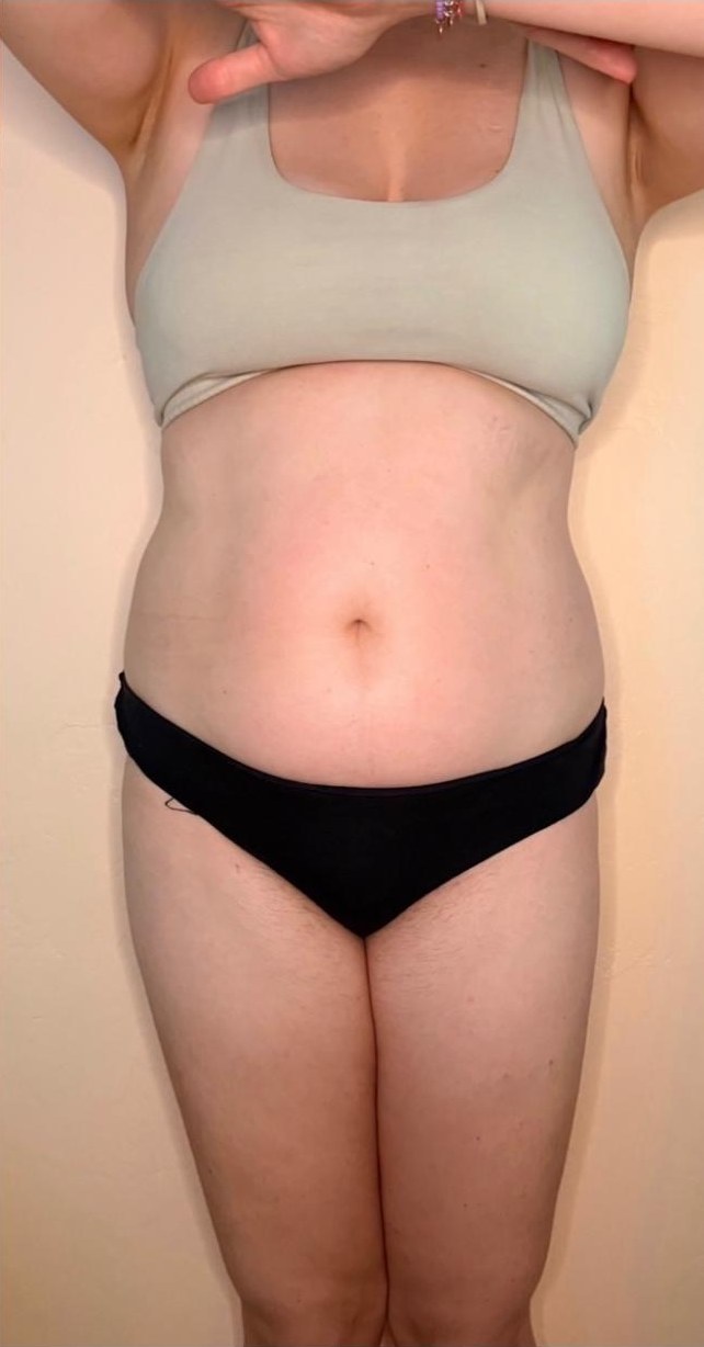 After — a real client's midsection, before and after manual lymphatic drainage at the Pacific Beach studio