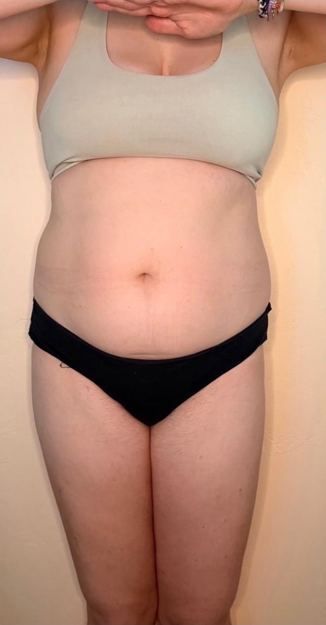 Before — a real client's midsection, before and after manual lymphatic drainage at the Pacific Beach studio
